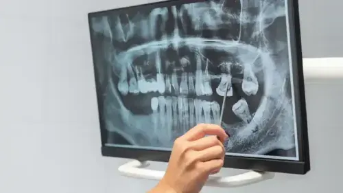 What is the Cost of Overbite Treatment in India?